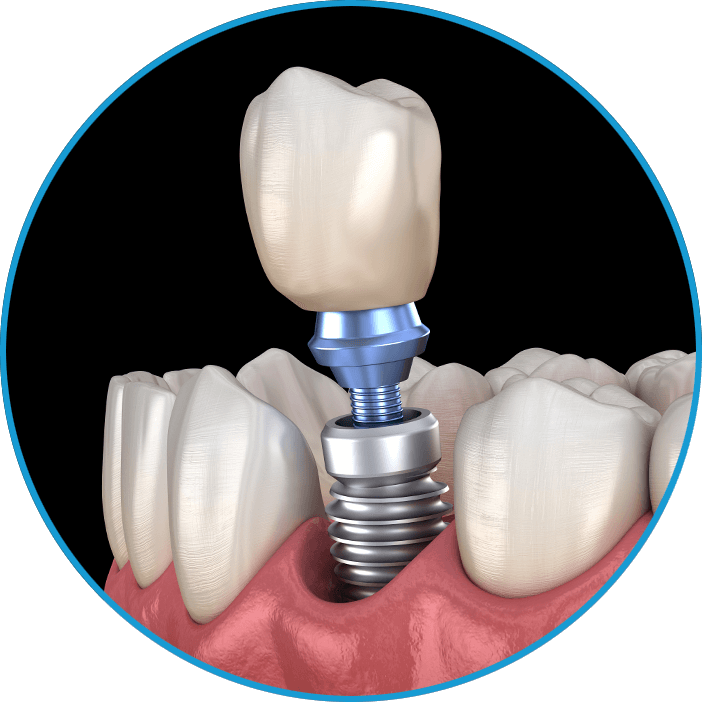 dental implant 3d cir
