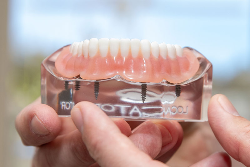 full arch held by dr front