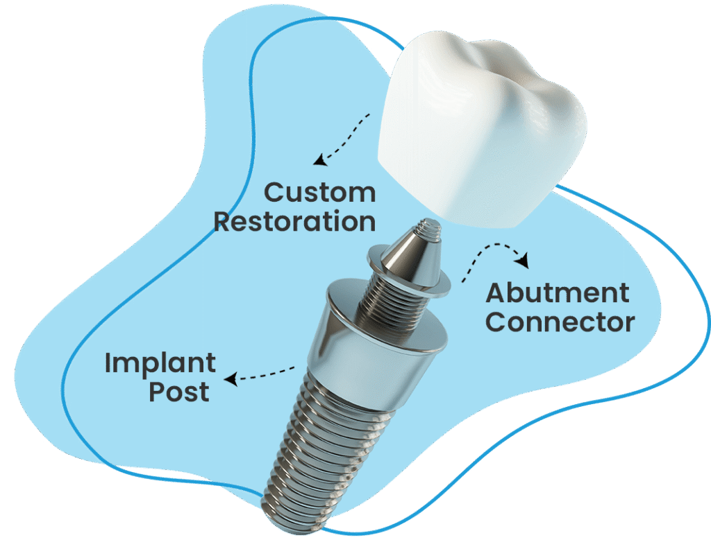 3 parts of dental implant with arrows