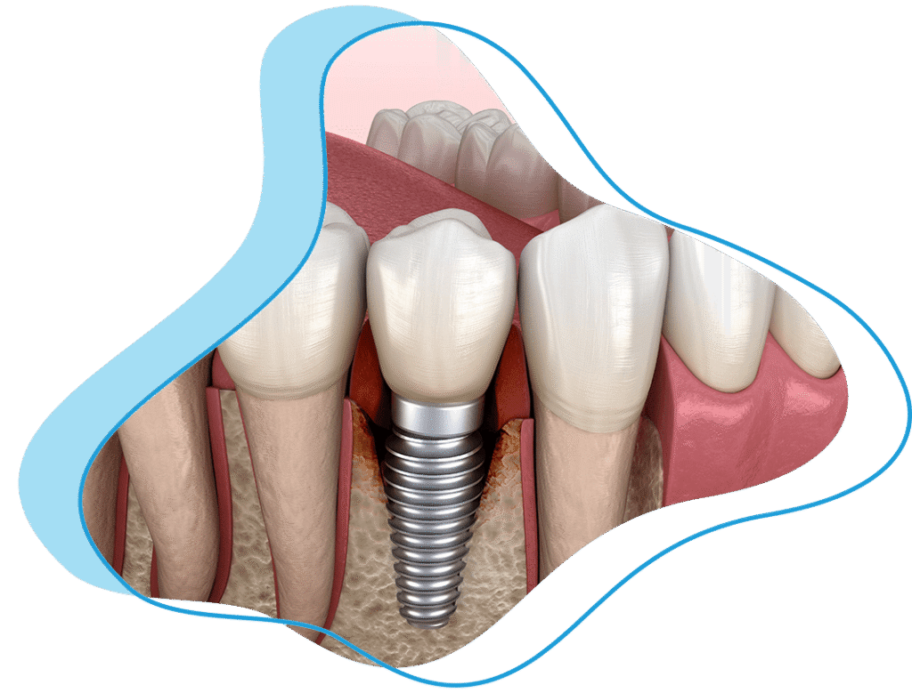 implant failure graphic