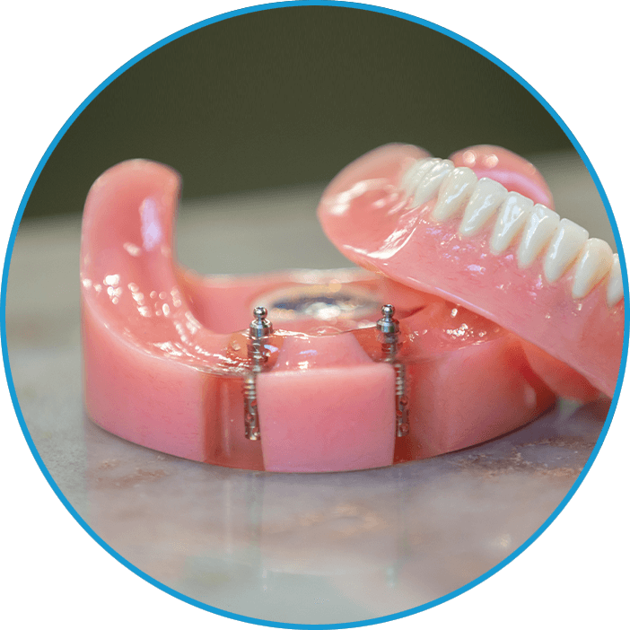 implant supported denture real