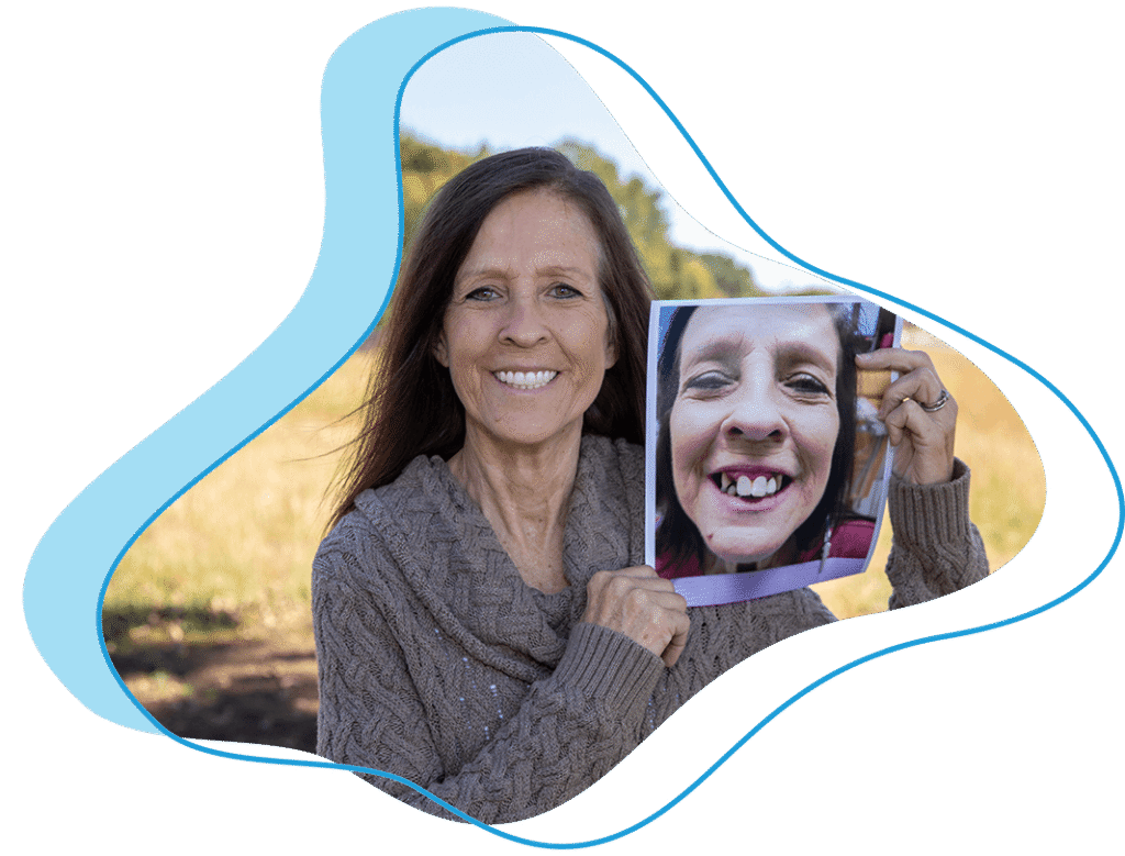 lady with after photo after full arch