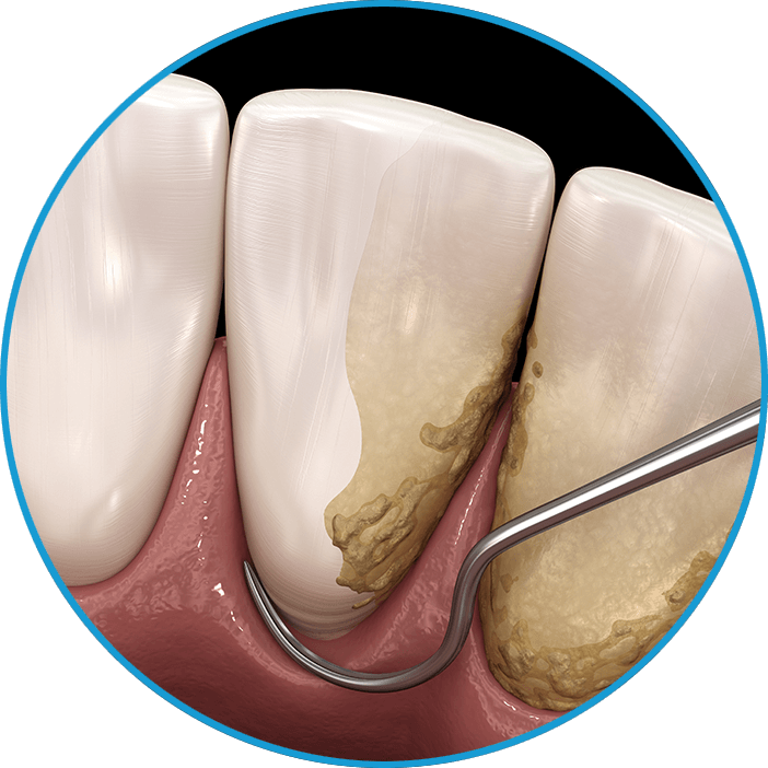 scaling and root planing procedure 3d