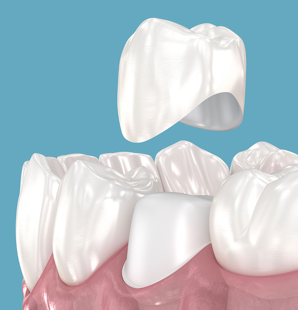 dental crown