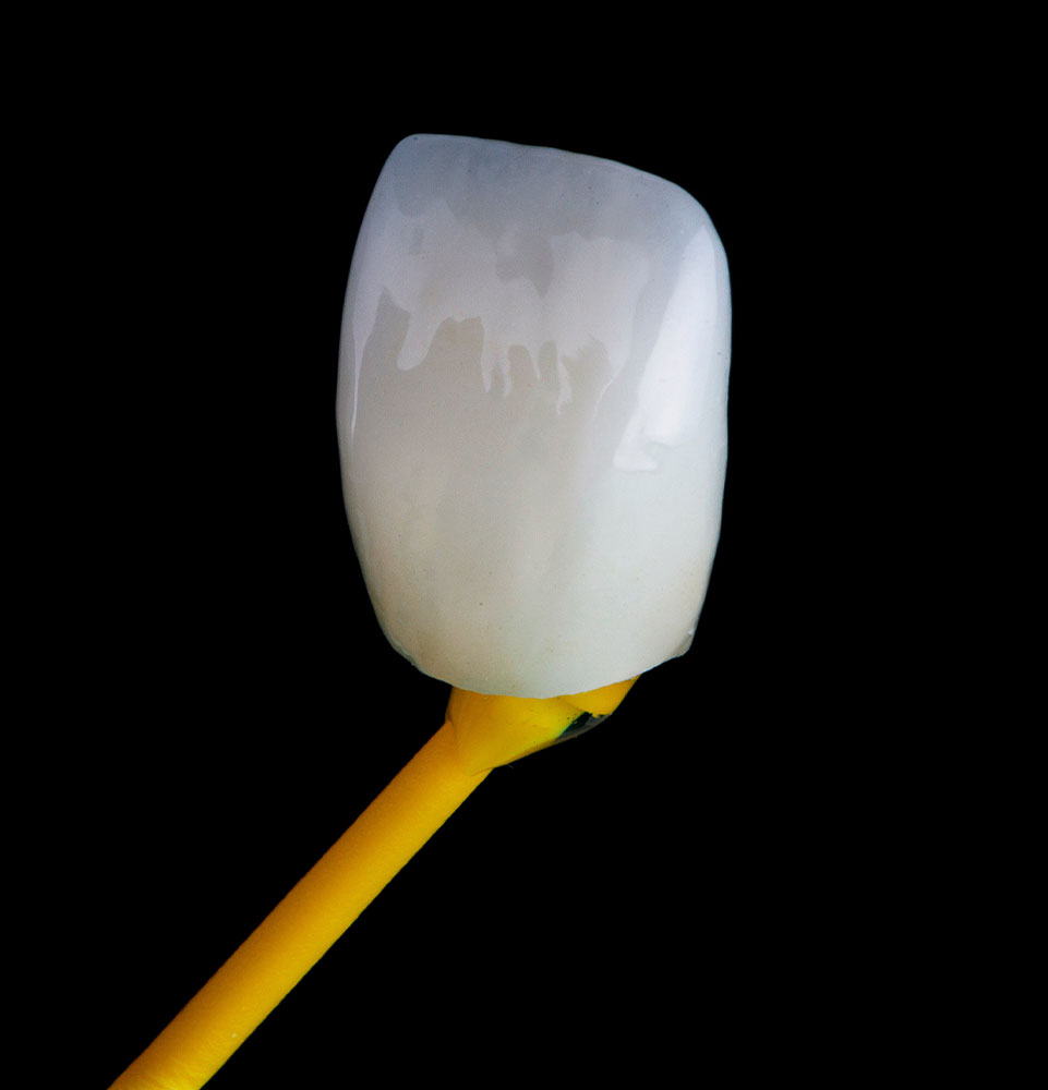 dental veneer